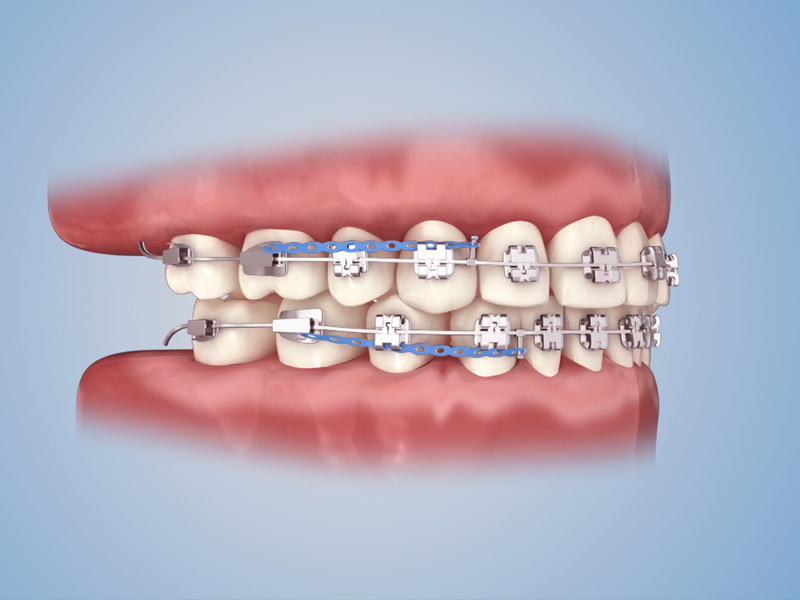 三维医学原理动画，工业机械3d仿真动画_托槽原理动画_工业产品3d渲染动画制作,工业演示3d动画制作