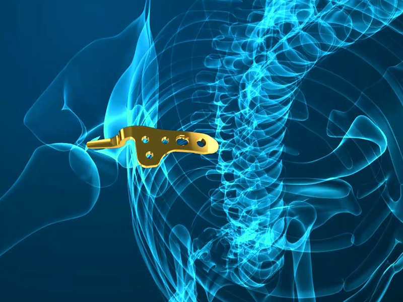 医学动画，医学原理动画，3d接骨板动画演示-医疗机械动画_二维mg动画_医学科普动画